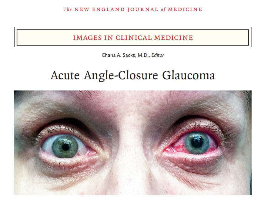 open angle glaucoma eye