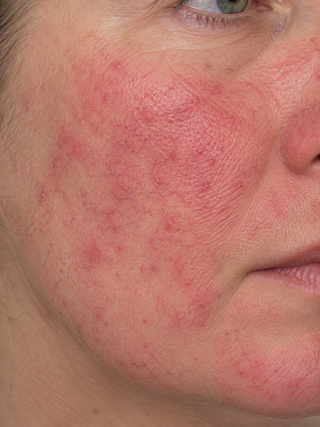 Concise guide to Rosacea