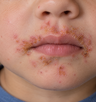 Concise guide to impetigo