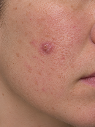Concise guide to Skin Lesions