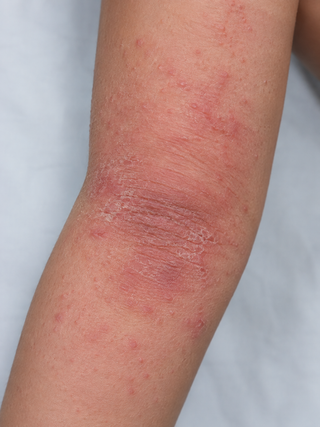 Concise guide to Atopic Dermatitis