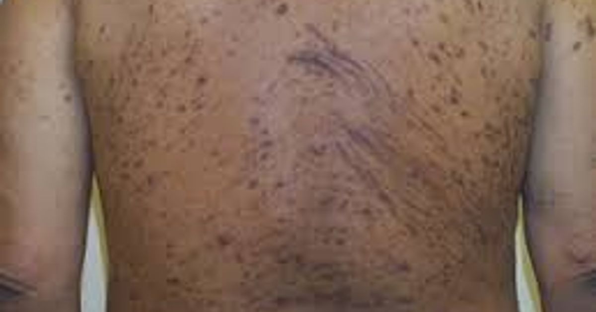 Chronic Kidney Disease associatedPruritus Case Discussion